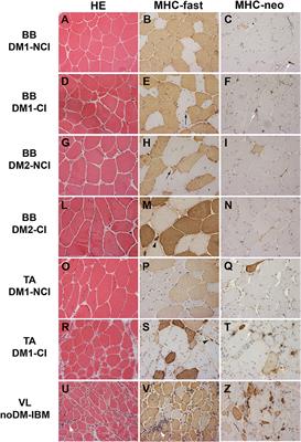 TNNT2 Missplicing in Skeletal Muscle as a Cardiac Biomarker in Myotonic Dystrophy Type 1 but Not in Myotonic Dystrophy Type 2